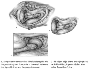 B, The posterior semicircular canal is identified and
the posterior fossa dura plate is removed between
the sigmoid sinus and the posterior canal.
C,The upper edge of the endolymphatic
sac is identified; it generally lies at or
below Donaldson’s line
 