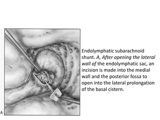 Endolymphatic subarachnoid
shunt. A, After opening the lateral
wall of the endolymphatic sac, an
incision is made into the medial
wall and the posterior fossa to
open into the lateral prolongation
of the basal cistern.
 