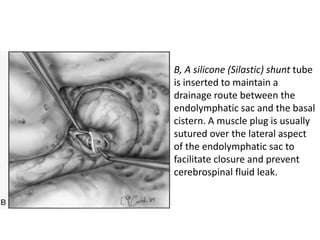 B, A silicone (Silastic) shunt tube
is inserted to maintain a
drainage route between the
endolymphatic sac and the basal
cistern. A muscle plug is usually
sutured over the lateral aspect
of the endolymphatic sac to
facilitate closure and prevent
cerebrospinal fluid leak.
 