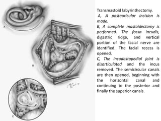 Transmastoid labyrinthectomy.
A, A postauricular incision is
made.
B, A complete mastoidectomy is
performed. The fossa incudis,
digastric ridge, and vertical
portion of the facial nerve are
identified. The facial recess is
opened.
C, The incudostapedial joint is
disarticulated and the incus
removed. The semicircular canals
are then opened, beginning with
the horizontal canal and
continuing to the posterior and
finally the superior canals.
 