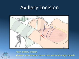 Minimally invasive thyroid surgery by A. Shaha | PDF