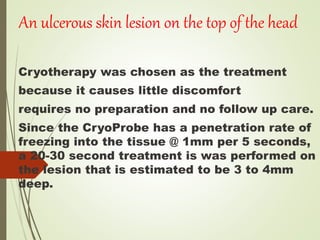 Cryotherapy was chosen as the treatment
because it causes little discomfort
requires no preparation and no follow up care.
Since the CryoProbe has a penetration rate of
freezing into the tissue @ 1mm per 5 seconds,
a 20-30 second treatment is was performed on
the lesion that is estimated to be 3 to 4mm
deep.
An ulcerous skin lesion on the top of the head
 