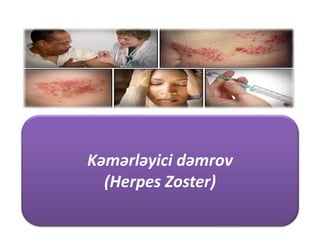 Kəmərli Dəmrov
Herpes Zoster
Kəmərləyici dəmrov
(Herpes Zoster)
 