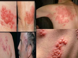 Kəmərləyici dəmrov (herpes zoster )