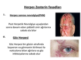 Herpes Zosterin fəsadları
Herpes sonrası nevralgiya(PHN)
Post Herpetik Nevralgiya uçuqlardan
sonra davam edən şiddətli sinir ağrılarına
səbəb ola bilər
Göz Herpesi
Göz Herpesi bir gözün ətrafında
başverən və görmənin itirilməsi ilə
nəticələnə bilən ağrılara və göz
infeksiyalarına səbəb olur
 