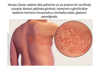 Herpes Zoster adətən döş qəfəsinin və ya arxanın bir tərəfində
suluqlar dəstəsi şəklində görünür, həmçinin o görülə bilər
bədənin hərhansı hissəsində,o cümlədən,üzdə, gözlərin
yaxınlığında.
 