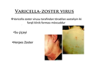 Suçiçəyi
Herpes Zoster
VVaricella zoster virusu tərəfindən törədilən xəstəliyin iki
fərqli klinik forması mövcuddur
•Su çiçəyi
•Herpes Zoster
 