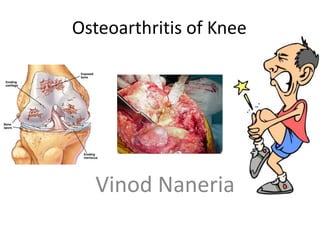 Osteoarthritis of Knee

Vinod Naneria

 