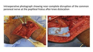 Intraoperative photograph showing near-complete disruption of the common
peroneal nerve at the popliteal hiatus after knee dislocation
 
