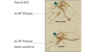 Test of ACL
At 90° Flexion
At 30° Flexion
(more sensitive)
 