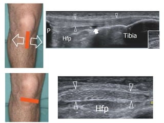 Updated lecture about Ultrasonography of the knee | PPTX
