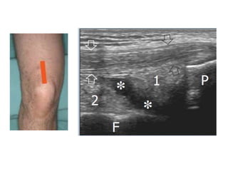 Updated lecture about Ultrasonography of the knee | PPTX