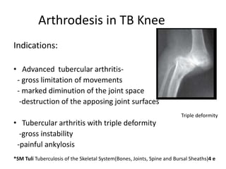 Arthrodesis in TB Knee
Indications:
• Advanced tubercular arthritis-
- gross limitation of movements
- marked diminution of the joint space
-destruction of the apposing joint surfaces
• Tubercular arthritis with triple deformity
-gross instability
-painful ankylosis
*SM Tuli Tuberculosis of the Skeletal System(Bones, Joints, Spine and Bursal Sheaths)4 e
Triple deformity
 