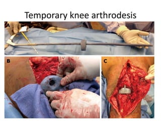 Temporary knee arthrodesis
 