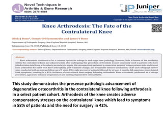 This study demonstrates the presence pathologic advancement of
degenerative osteoarthritis in the contralateral knee following arthrodesis
in a select patient cohort. Arthrodesis of the knee creates adverse
compensatory stresses on the contralateral knee which lead to symptoms
in 58% of patients and the need for surgery in 42%.
 