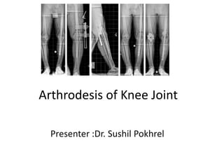 Arthrodesis of Knee Joint
Presenter :Dr. Sushil Pokhrel
 