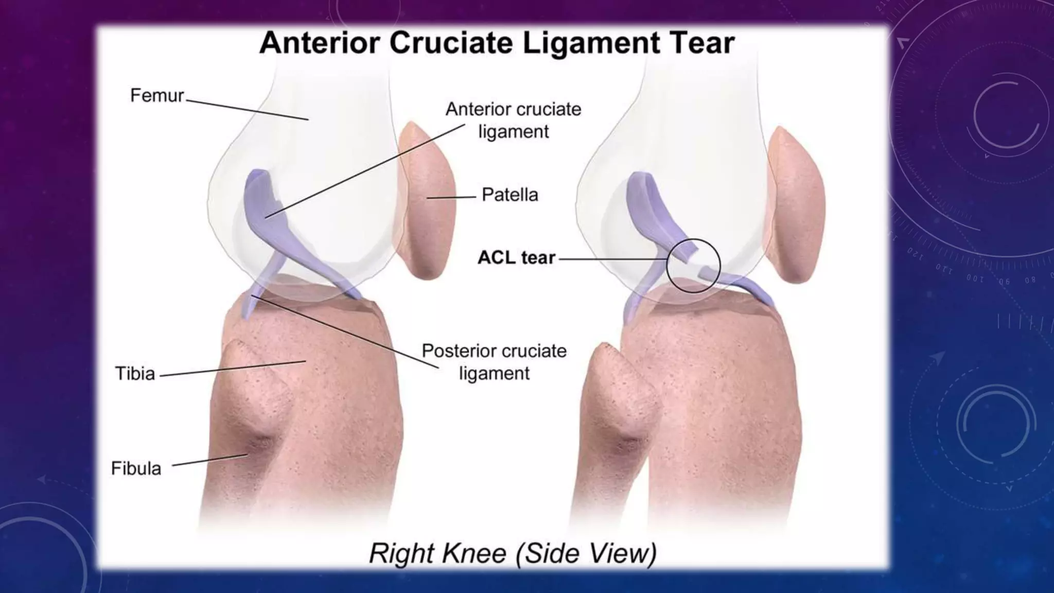 ACL anterior crucitae ligament anamtomy and physical therapy | PPTX