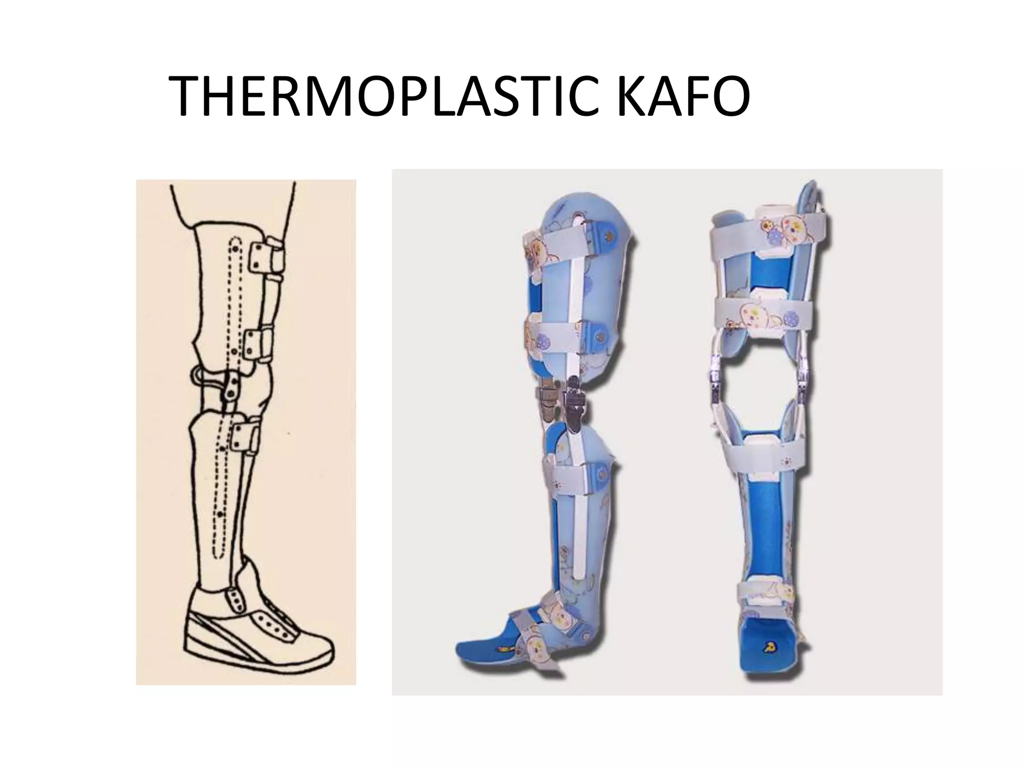 KNEE ANKLE FOOT ORTHOSIS.pptx