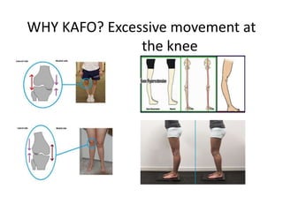 WHY KAFO? Excessive movement at
the knee
 