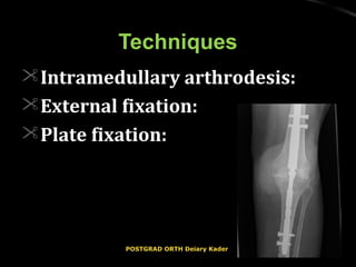 TechniquesTechniques
Intramedullary arthrodesis:Intramedullary arthrodesis:
External fixation:External fixation:
Plate fixation:Plate fixation:
POSTGRAD ORTH Deiary KaderPOSTGRAD ORTH Deiary Kader
 