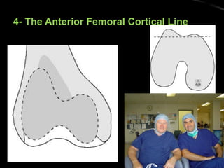 4- The Anterior Femoral Cortical Line4- The Anterior Femoral Cortical Line
 