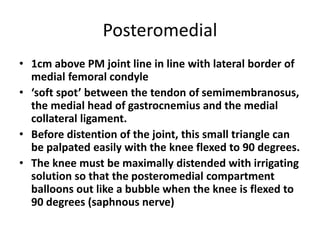 Posteromedial
• 1cm above PM joint line in line with lateral border of
medial femoral condyle
• ‘soft spot’ between the tendon of semimembranosus,
the medial head of gastrocnemius and the medial
collateral ligament.
• Before distention of the joint, this small triangle can
be palpated easily with the knee flexed to 90 degrees.
• The knee must be maximally distended with irrigating
solution so that the posteromedial compartment
balloons out like a bubble when the knee is flexed to
90 degrees (saphnous nerve)
 