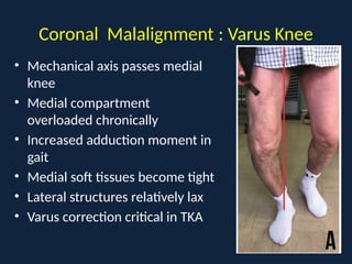 Comprehensive Biomechanics and Alignment in Total Knee Arthroplasty | PPTX