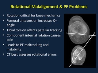 Pf Malalignment Comprehensive Biomechanics and Alignment in Total Knee Arthroplasty | PPTX