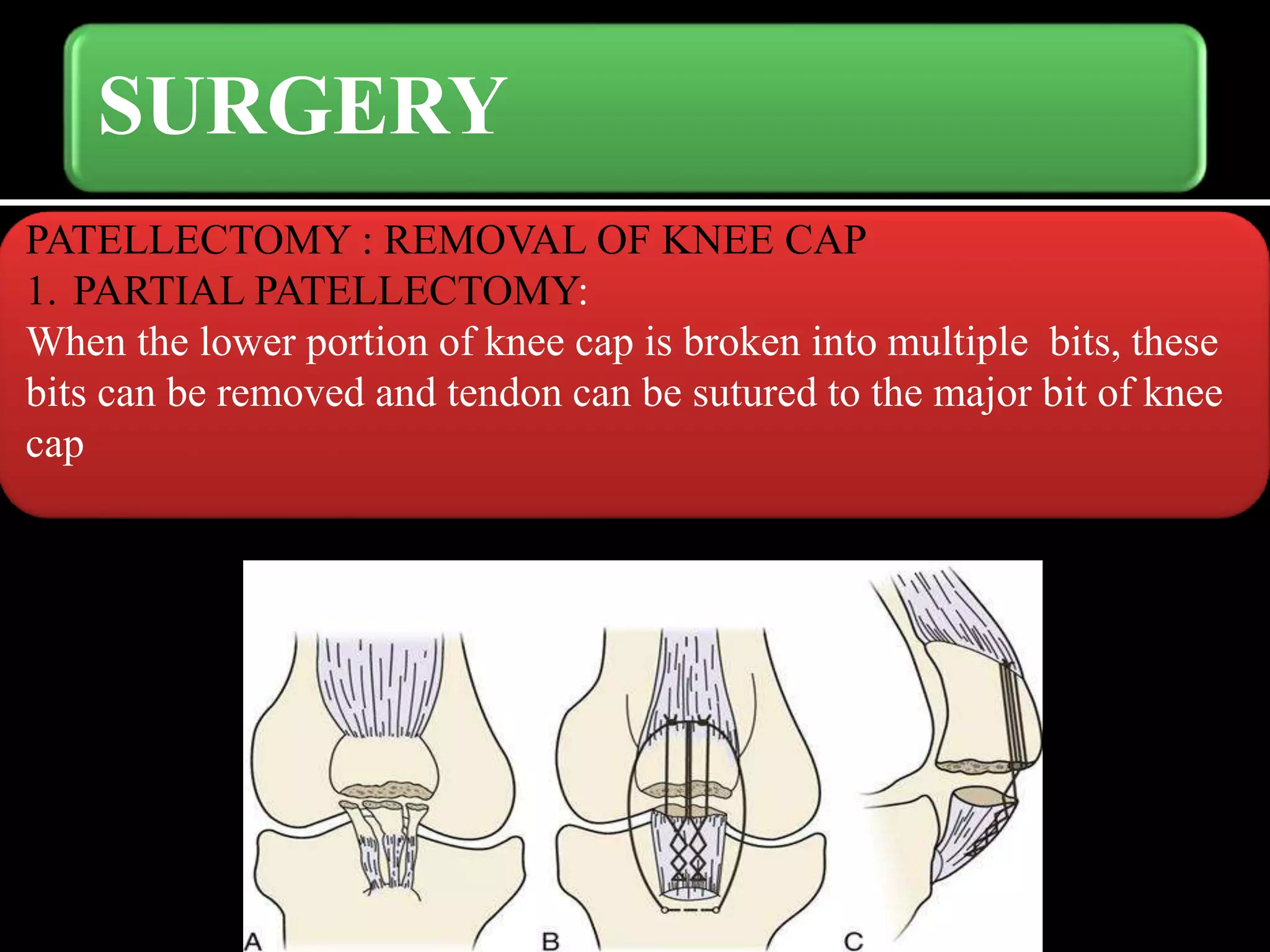 knee-cap-patella-fractures-pptx