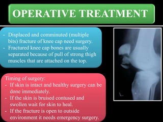 OPERATIVE TREATMENT
- Displaced and comminuted (multiple
bits) fracture of knee cap need surgery.
- Fractured knee cap bones are usually
separated because of pull of strong thigh
muscles that are attached on the top.
Timing of surgery:
- If skin is intact and healthy surgery can be
done immediately.
- If the skin is bruised contused and
swollen wait for skin to heal.
- If the fracture is open to outside
environment it needs emergency surgery.
 