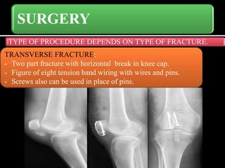 SURGERY
TYPE OF PROCEDURE DEPENDS ON TYPE OF FRACTURE.
TRANSVERSE FRACTURE:
- Two part fracture with horizontal break in knee cap.
- Figure of eight tension band wiring with wires and pins.
- Screws also can be used in place of pins.
 