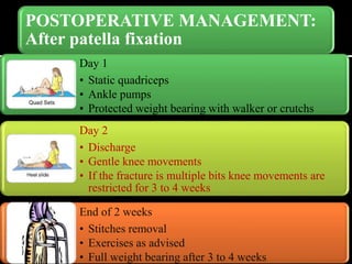 POSTOPERATIVE MANAGEMENT:
After patella fixation
Day 1
• Static quadriceps
• Ankle pumps
• Protected weight bearing with walker or crutchs
Day 2
• Discharge
• Gentle knee movements
• If the fracture is multiple bits knee movements are
restricted for 3 to 4 weeks
End of 2 weeks
• Stitches removal
• Exercises as advised
• Full weight bearing after 3 to 4 weeks
 