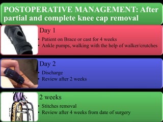 POSTOPERATIVE MANAGEMENT: After
partial and complete knee cap removal
Day 1
• Patient on Brace or cast for 4 weeks
• Ankle pumps, walking with the help of walker/crutches
Day 2
• Discharge
• Review after 2 weeks
2 weeks
• Stitches removal
• Review after 4 weeks from date of surgery
 