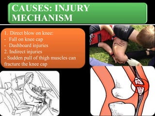 CAUSES: INJURY
MECHANISM
1. Direct blow on knee:
- Fall on knee cap
- Dashboard injuries
2. Indirect injuries
- Sudden pull of thigh muscles can
fracture the knee cap
 