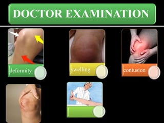 DOCTOR EXAMINATION
deformity swelling contusion
 