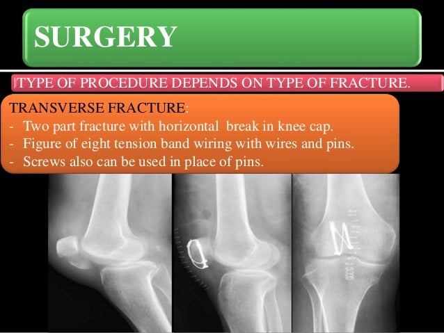 Knee cap (Patella) fractures
