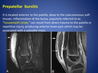 Prepatellar bursitis
It is located anterior to the patella, deep to the subcutaneous soft
tissues. Inflammation of the bursa, popularly referred to as
"housemaid's knee," can result from direct trauma to the patella or
repetitive injury, producing anterior knee pain which may be
associated with a palpable mass.
 