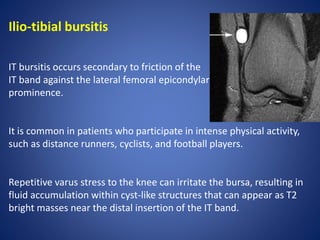 Ilio-tibial bursitis
IT bursitis occurs secondary to friction of the
IT band against the lateral femoral epicondylar
prominence.
It is common in patients who participate in intense physical activity,
such as distance runners, cyclists, and football players.
Repetitive varus stress to the knee can irritate the bursa, resulting in
fluid accumulation within cyst-like structures that can appear as T2
bright masses near the distal insertion of the IT band.
 
