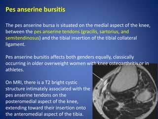 Pes anserine bursitis
The pes anserine bursa is situated on the medial aspect of the knee,
between the pes anserine tendons (gracilis, sartorius, and
semitendinosus) and the tibial insertion of the tibial collateral
ligament.
Pes anserine bursitis affects both genders equally, classically
occurring in older overweight women with knee osteoarthritis or in
athletes.
On MRI, there is a T2 bright cystic
structure intimately associated with the
pes anserine tendons on the
posteromedial aspect of the knee,
extending toward their insertion onto
the anteromedial aspect of the tibia.
 