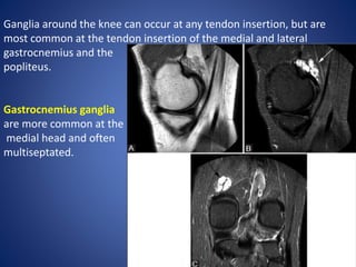 Ganglia around the knee can occur at any tendon insertion, but are
most common at the tendon insertion of the medial and lateral
gastrocnemius and the
popliteus.
Gastrocnemius ganglia
are more common at the
medial head and often
multiseptated.
 