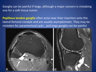 Ganglia can be painful if large, although a major concern is mistaking
one for a soft-tissue tumor.
Popliteus tendon ganglia often arise near their insertion onto the
lateral femoral condyle and are usually asymptomatic. They may be
mistaken for parameniscal cysts , and large ganglia can be painful
 