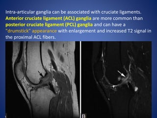 Intra-articular ganglia can be associated with cruciate ligaments.
Anterior cruciate ligament (ACL) ganglia are more common than
posterior cruciate ligament (PCL) ganglia and can have a
"drumstick" appearance with enlargement and increased T2 signal in
the proximal ACL fibers.
 
