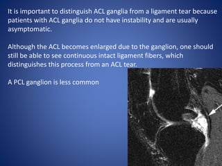 It is important to distinguish ACL ganglia from a ligament tear because
patients with ACL ganglia do not have instability and are usually
asymptomatic.
Although the ACL becomes enlarged due to the ganglion, one should
still be able to see continuous intact ligament fibers, which
distinguishes this process from an ACL tear.
A PCL ganglion is less common
 
