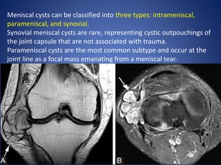 Meniscal cysts can be classified into three types: intrameniscal,
parameniscal, and synovial.
Synovial meniscal cysts are rare, representing cystic outpouchings of
the joint capsule that are not associated with trauma.
Parameniscal cysts are the most common subtype and occur at the
joint line as a focal mass emanating from a meniscal tear.
 