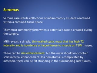 Seromas
Seromas are sterile collections of inflammatory exudate contained
within a confined tissue space.
They most commonly form when a potential space is created during
the surgery.
MRI reveals a simple, thin-walled cystic mass that has high T2
intensity and is isointense or hypointense to muscle on T1W images.
There can be rim enhancement, but the mass should not contain
solid internal enhancement. If a hematoma is complicated by
infection, there can be fat stranding in the surrounding soft tissues.
 