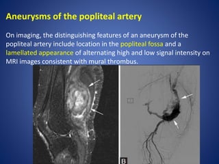 Aneurysms of the popliteal artery
On imaging, the distinguishing features of an aneurysm of the
popliteal artery include location in the popliteal fossa and a
lamellated appearance of alternating high and low signal intensity on
MRI images consistent with mural thrombus.
 