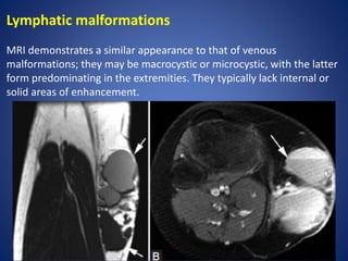 Lymphatic malformations
MRI demonstrates a similar appearance to that of venous
malformations; they may be macrocystic or microcystic, with the latter
form predominating in the extremities. They typically lack internal or
solid areas of enhancement.
 