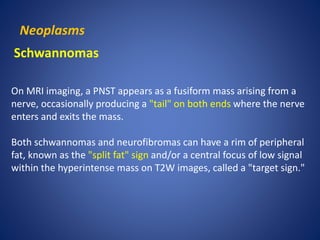 Neoplasms
Schwannomas
On MRI imaging, a PNST appears as a fusiform mass arising from a
nerve, occasionally producing a "tail" on both ends where the nerve
enters and exits the mass.
Both schwannomas and neurofibromas can have a rim of peripheral
fat, known as the "split fat" sign and/or a central focus of low signal
within the hyperintense mass on T2W images, called a "target sign."
 