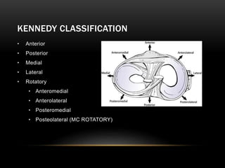 KENNEDY CLASSIFICATION
• Anterior
• Posterior
• Medial
• Lateral
• Rotatory
• Anteromedial
• Anterolateral
• Posteromedial
• Posteolateral (MC ROTATORY)
 