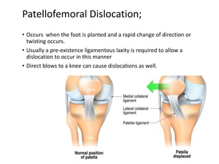 Patellofemoral Dislocation;
• Occurs when the foot is planted and a rapid change of direction or
twisting occurs.
• Usually a pre-existence ligamentous laxity is required to allow a
dislocation to occur in this manner
• Direct blows to a knee can cause dislocations as well.
 